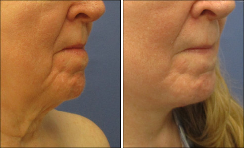 facelift